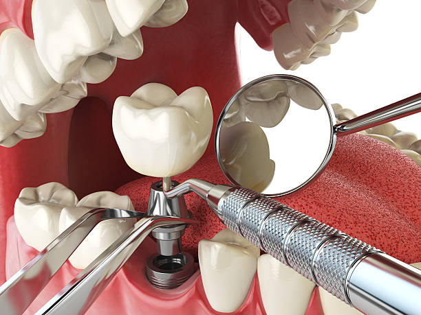 Best Emergency Dental Extractions in Waldpt, OR